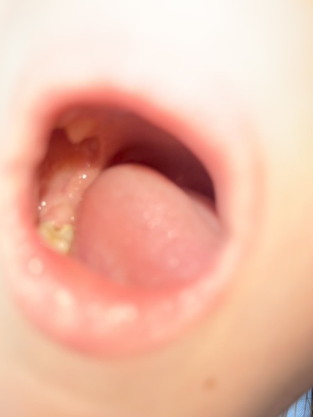 Sudden cavity in 9 year old