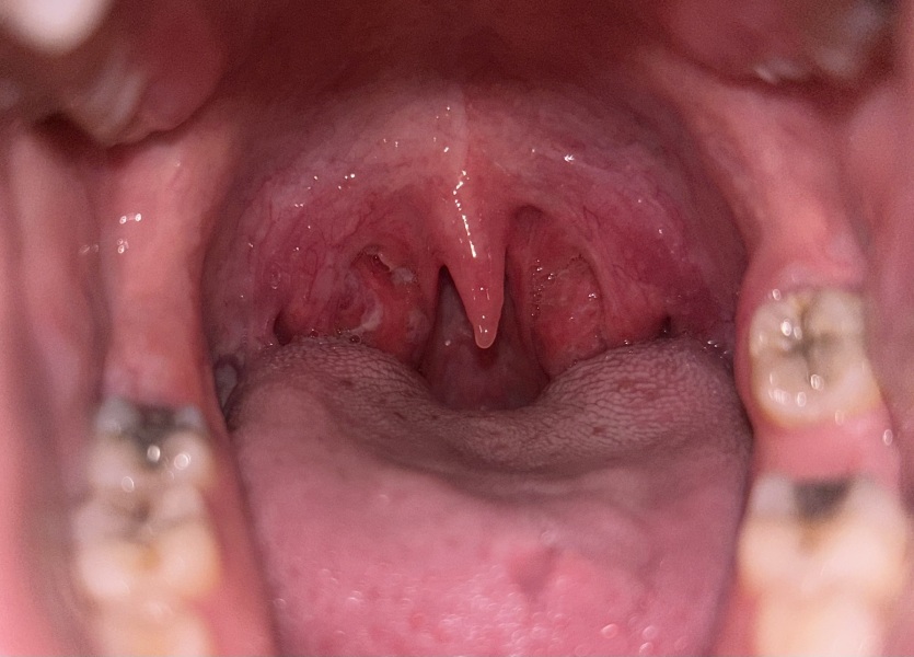 What do you think this is tonsillitis or no ?!