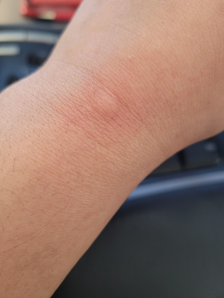 WTF is biting me?!