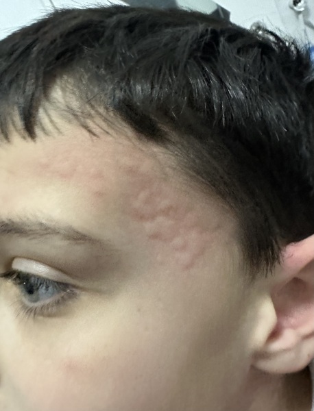 8 year old suddenly came out in hives yesterday, now it’s happened again