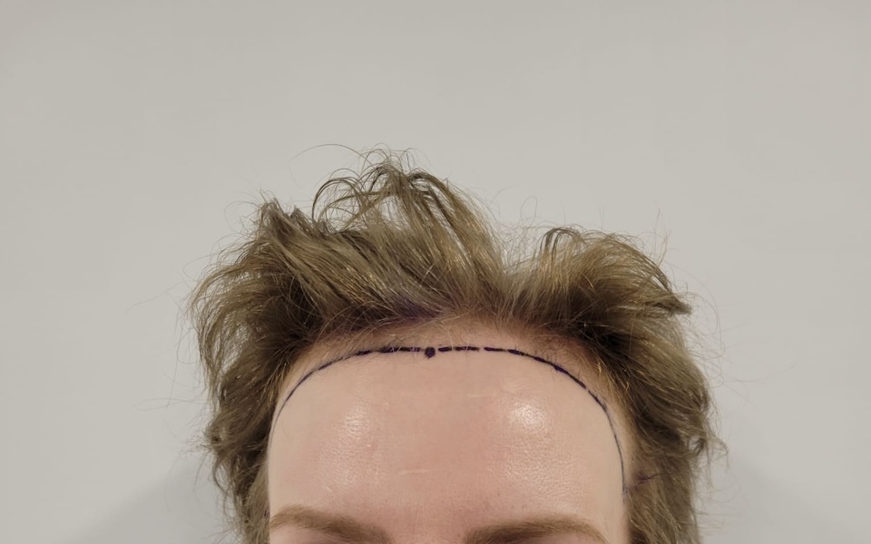 I’ve just had a hair transplant AMA
