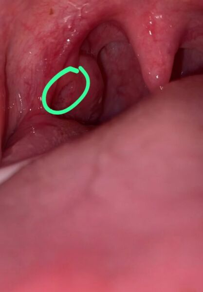 Help, what is this on my tonsils?! (Pic)