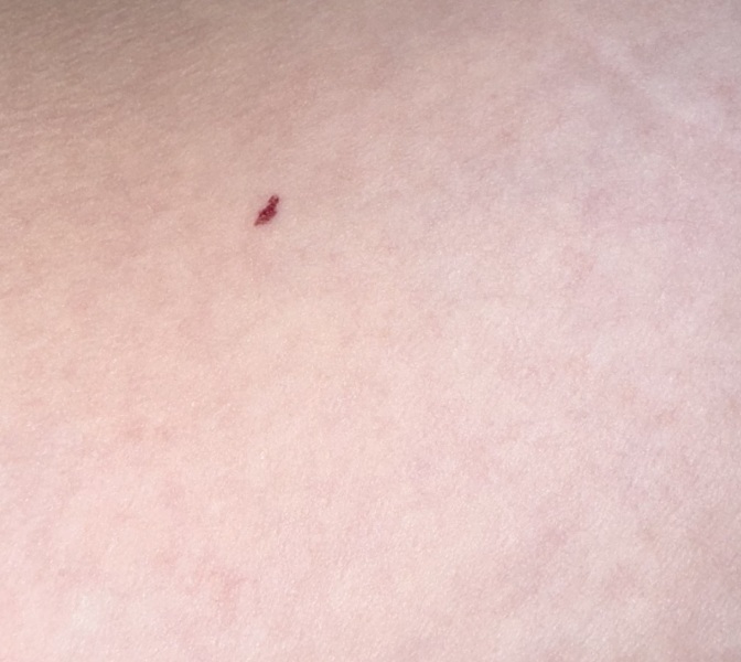 Blood dot appearing on breast?