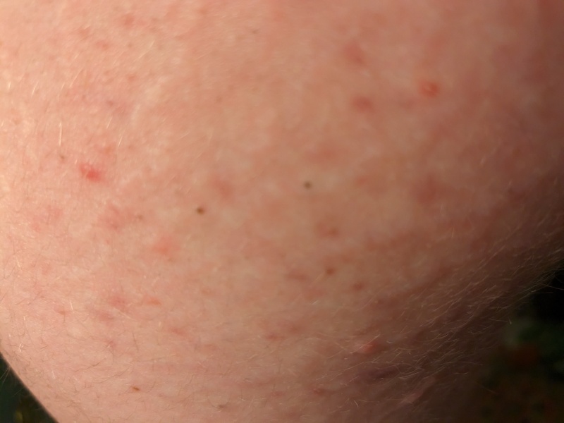 Doc said acne can't present on top of l legs :pic included and moisteriser advice.
