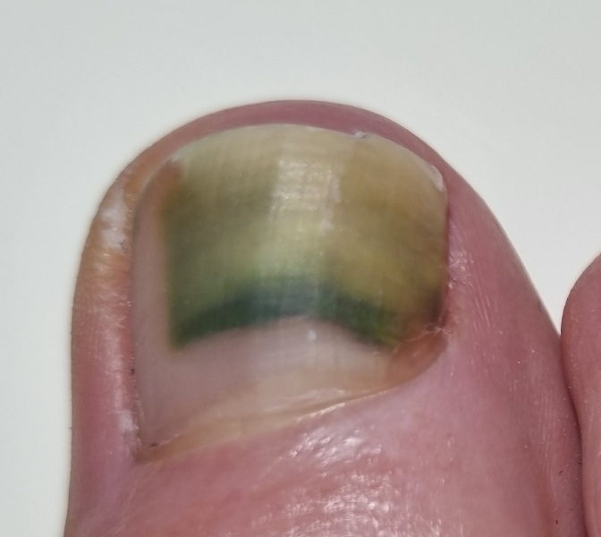 Could this be melanoma ?