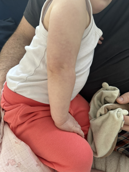 Is this mottled skin in toddler ??