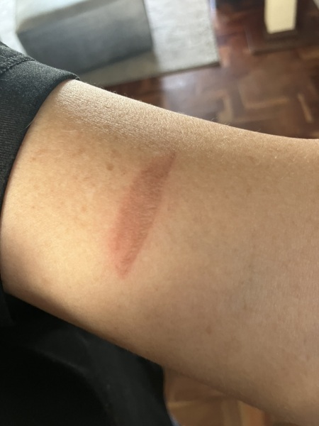What is this strange, burn-like mark on my arm? Pic