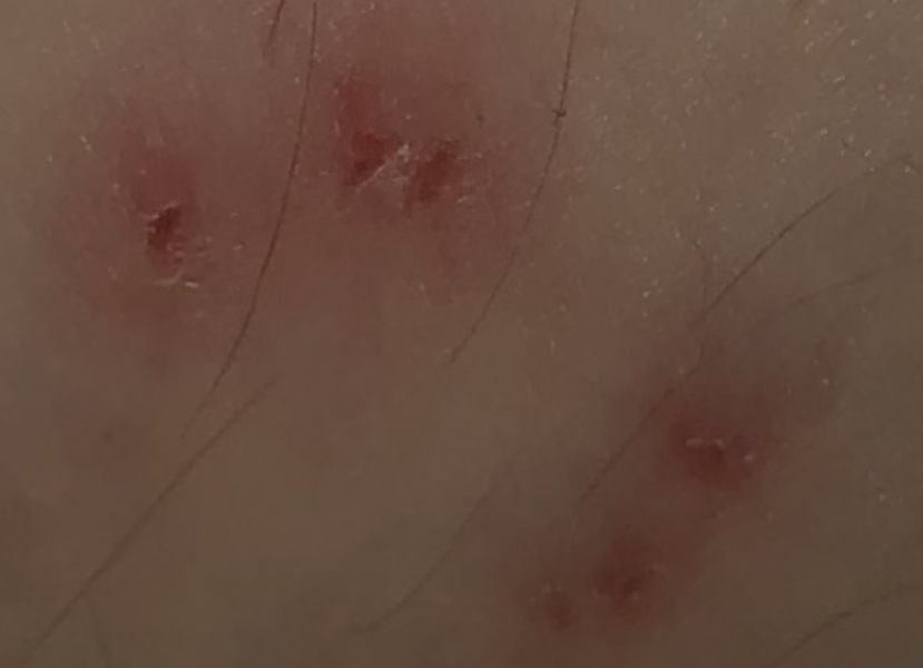 To ask what is this on the back of my calf? Scabies?