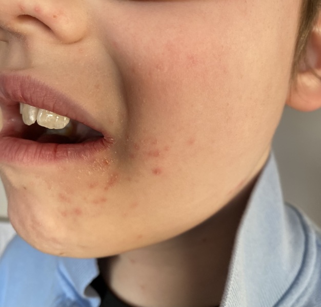 Face rash/spots? Any ideas?