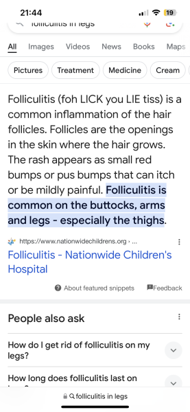 Doc said acne can't present on top of l legs :pic included and moisteriser advice.