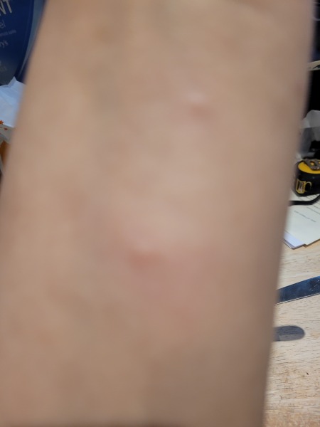 WTF is biting me?!