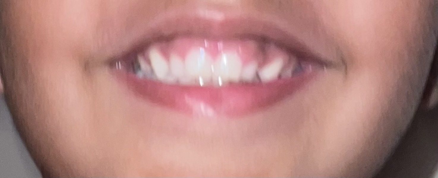 Dark patches on gums