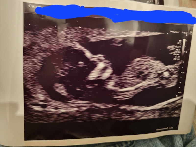 Boy or girl?! Nub theory.