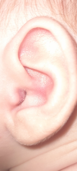 Babys ear canal swollen at entrance