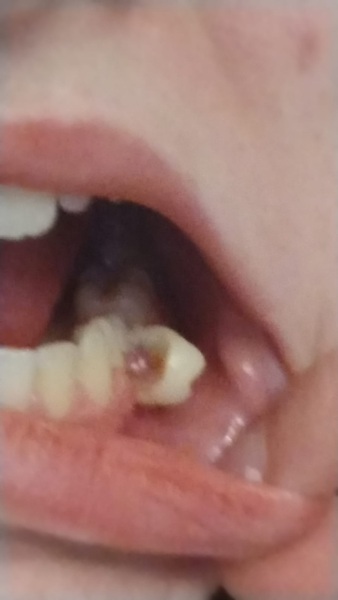 How do we get this tooth out (with photo)?