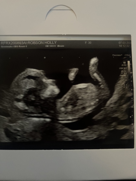 12weeks 2 days guess scan