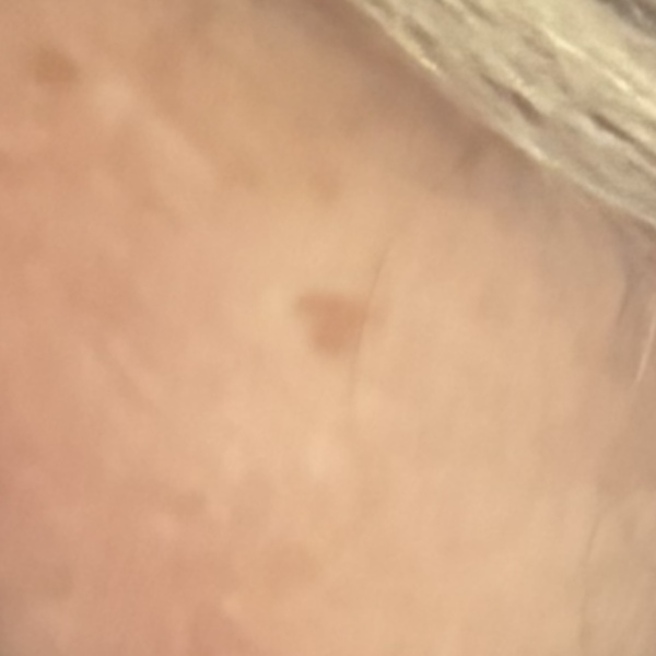 Could this freckle be melanoma?