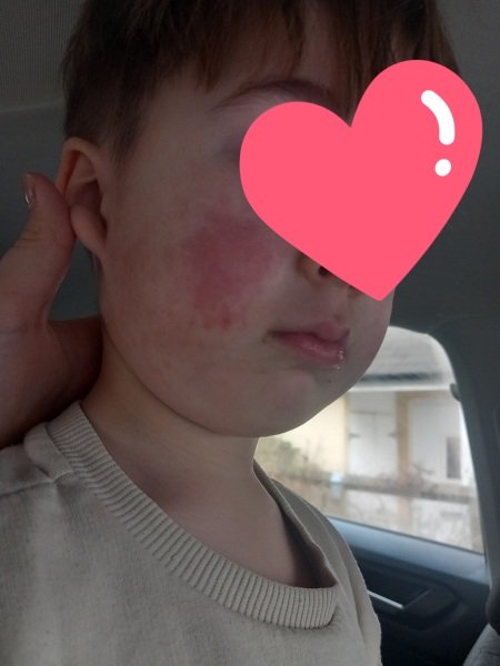 Rash on face