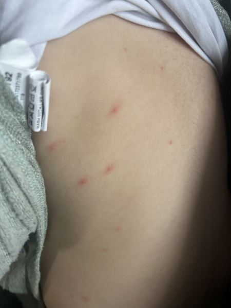 Chicken pox or MMR vaccine reaction?
