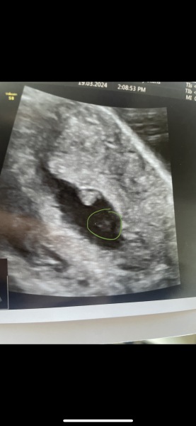 Heavy bleeding at 6 weeks - Twin pregnancy - One heartbeat