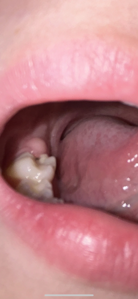 Sudden cavity in 9 year old