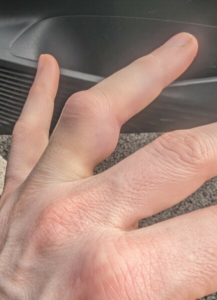 Would you seek medical attention for a potentially broken finger?
