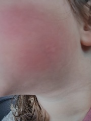 Rash photos - measles at nursery