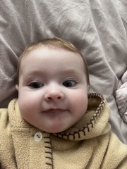 6 month old uneven cheeks.