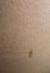 Mole swollen - should I be worried? (Pictures of mole)