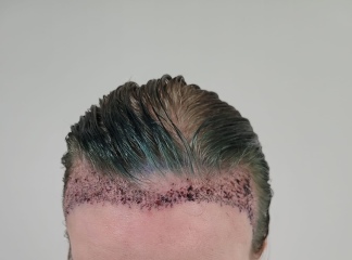 I’ve just had a hair transplant AMA