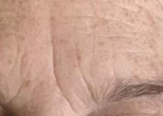 What’s the best wrinkle treatment?
