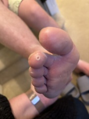 Foot ulcer? **WARNING PHOTO**