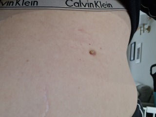 Waiting for Biopsy results cutaneous horn