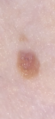 Does this mole warrant any concern?