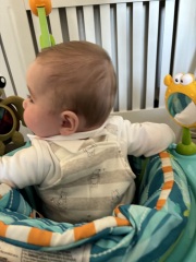 Is this Plagiocephaly? Also, does plageodephaly cause brain damage/delays?