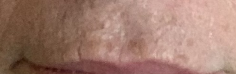 What’s the best wrinkle treatment?