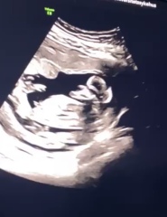Nub guess, 12w 5d scan