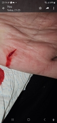 Did this need a stitch?