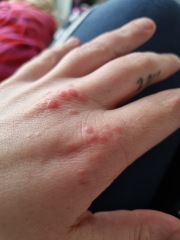 Bumps/blisters on hands