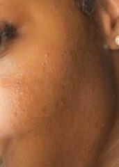 Will I ever be free from spots?!