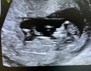 Boy or girl? Nub theory?