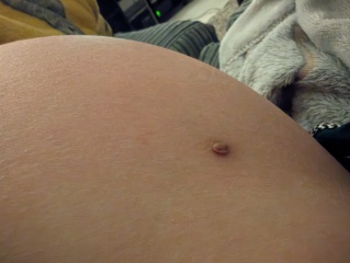 Mole swollen - should I be worried? (Pictures of mole)
