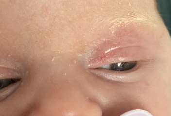 Milk allergy or colic? Warning nappy contents picture