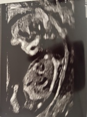 Has anyone had nub theory be wrong?