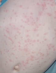 Rash on 3yr old- so many spots!