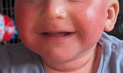 Is this an allergic reaction rash?