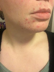 If your skin used to be bad but isn’t anymore, what worked?
