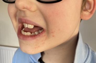 Face rash/spots? Any ideas?