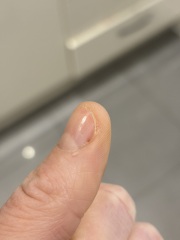 What could this dark spot on my thumbnail be?