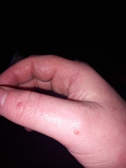 Bumps/blisters on hands